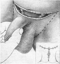Allungamento chirurgico del pene mediante estrazione della sua parte nascosta