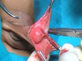 Ingrandimento chirurgico del pene per gli uomini